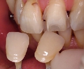 ラミネートベニア治療の治療中の写真です。シェード確認の様子。