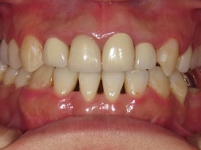 札幌南区北の沢夜間。審美歯科症例５。矯正後さらに再補綴後の写真。上顎の前歯は、根管治療、支台築造をほどこし、歯冠修復を行った。Ａ２シェード。