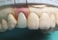 セラミック審美歯科の症例。製作されたセラミッククラウン。ｐ－ｍａｘ。ガム模型の写真。