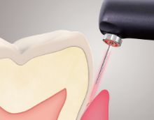 diagnodent pen の画像。