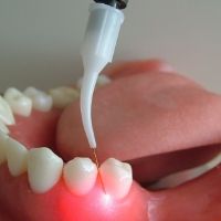 レーザー治療法。下顎の歯列模型で照射部位を示している写真。